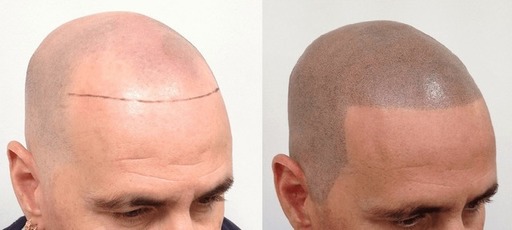 Best Scalp Micropigmentation in Abu Dhabi.jpg