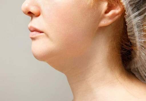 Double Chin Liposuction Dubai.jpg