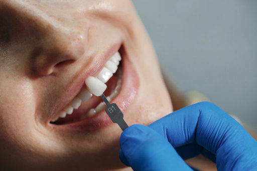 The Truth About Dental Veneers Separating Fact fro