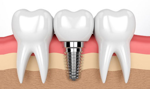 Understanding the Risks and Complications of Denta