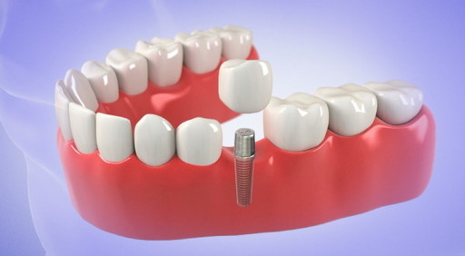 Dental Implants for Missing Teeth A Permanent Solu