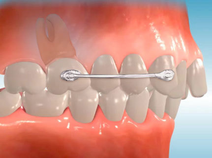 How to Choose the Right Dental Appliance for Your