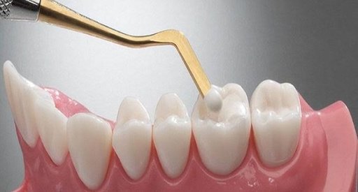 Composite Fillings vs. Silver Fillings Pros and Co