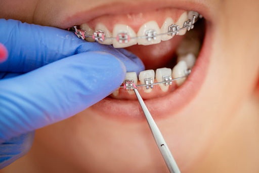 The Role of Metal Braces in Correcting Crooked Tee