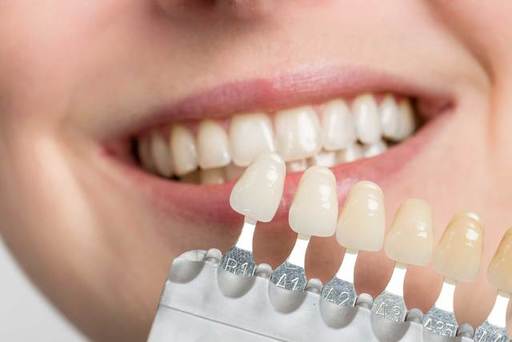 How to Choose the Right Dental Veneers Materials,