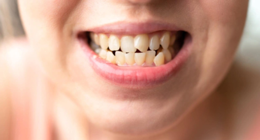 Straighten Your Teeth with These Simple Overlappin
