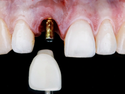 Dental Implant.png