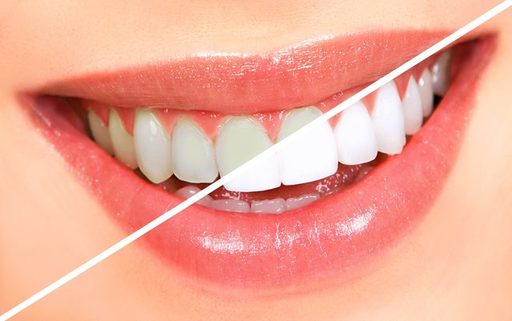 How to Choose the Right Teeth Whitening Kit for Yo