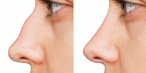 Is Rhinoplasty Permanent Results & Longevity.jpg