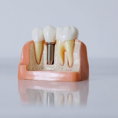 Immediate Dental Implants Get a New Smile in a Day