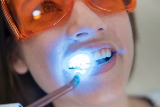A Whiter Smile in Less Time The Zoom Teeth Whiteni