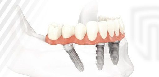 The Risks and Complications of Dental ImplantsWhat