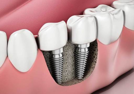 A Revolutionary Smile Fix The Benefits of Same-Day
