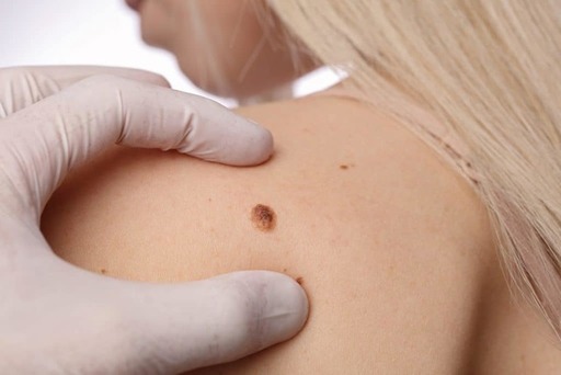 Why Skin Tag Removal Should Be on Your Skincare Ch