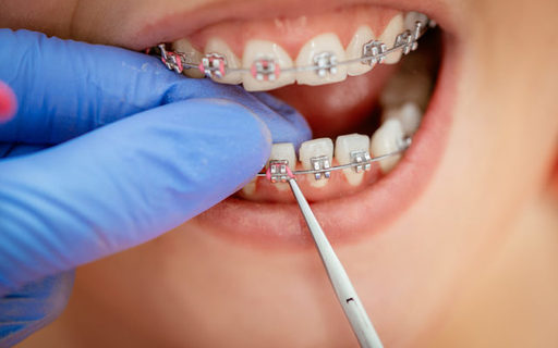 The Surprising Link Between Dental Braces and Over