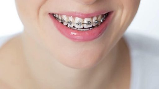 Why Retainers Matter After Braces Keeping Your Smi
