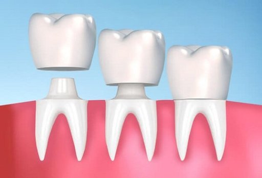 Why Choose Dental Crowns and Bridges for Your Teet