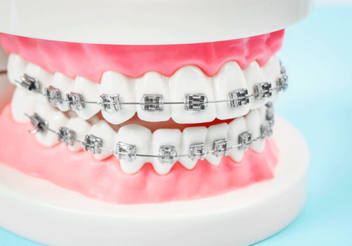The Role of Metal Braces in Treating Jaw Alignment