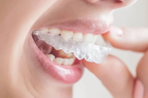The Cost of Aligners Are They Worth the Investment