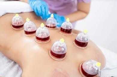 Hijama-.jpg