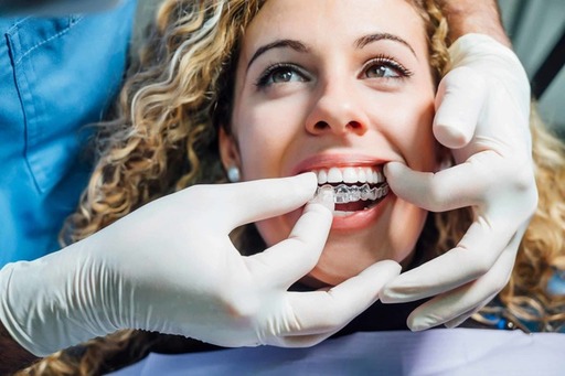 The Convenience of Aligners Achieving a Perfect Sm