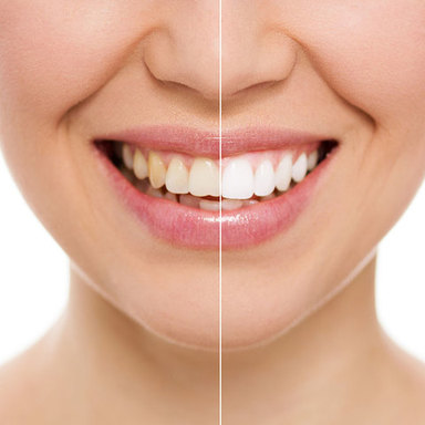Understanding Sensitivity After Teeth Whitening Tr