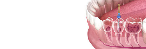 A Deep Dive Into Root Canal Treatment Benefits, Ri