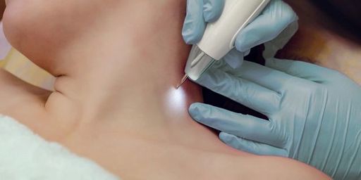 Preventing Skin Tags Tips for LongTerm Skin Health