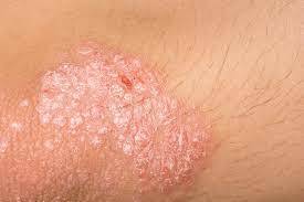 Skin Diseases treatment (1).jpg