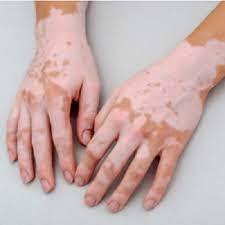 Skin Diseases treatment (2).jpg