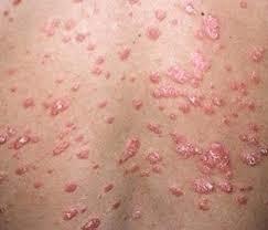 Skin Diseases treatment (3).jpg