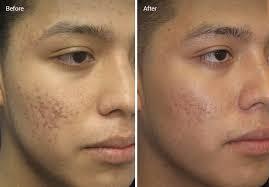 laser acne treatment.jpg