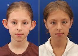 Earlobe correction surgery (2).jpg