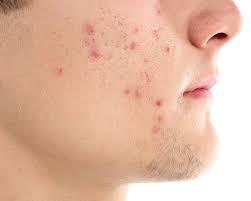 Acne Treatment (2).jpg