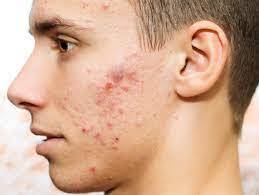 Acne Treatment (3).jpg